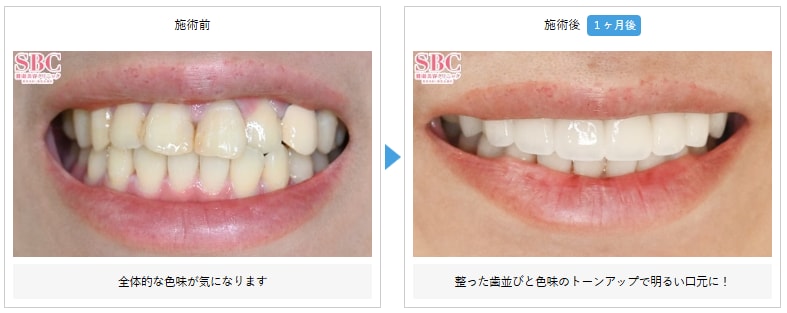 セラミック治療の術前と術後""